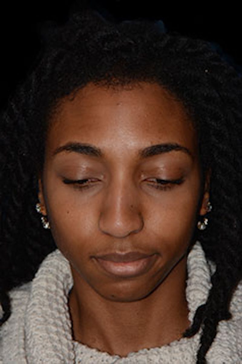 Rhinoplasty Before & After Gallery - Patient 265584 - Image 7