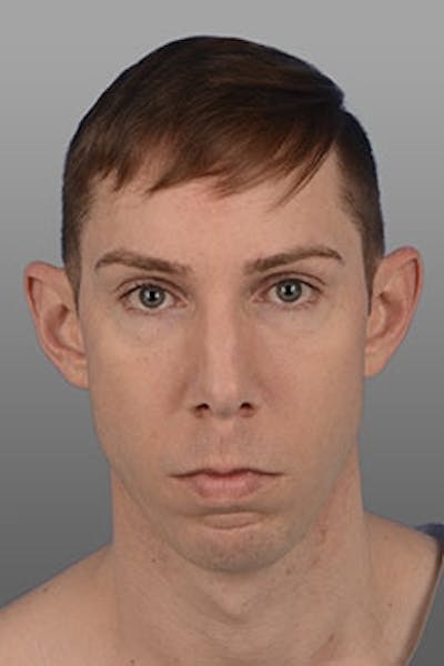 Otoplasty Before & After Gallery - Patient 189773 - Image 1