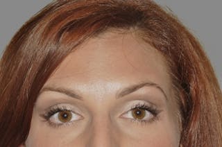 BOTOX© Cosmetic Before & After Gallery - Patient 112955 - Image 2