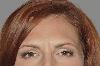 BOTOX© Cosmetic Before & After Gallery - Patient 112955 - Image 4