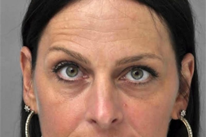 BOTOX© Cosmetic Before & After Gallery - Patient 322298 - Image 1
