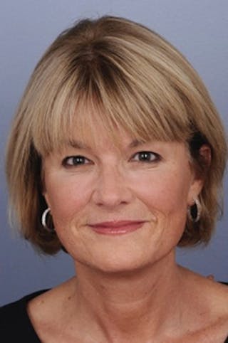 Comprehensive Facelift Before & After Gallery - Patient 313685 - Image 6