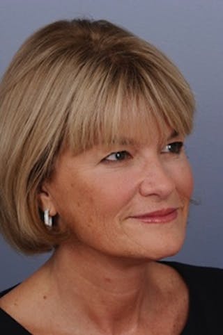 Comprehensive Facelift Before & After Gallery - Patient 313685 - Image 2