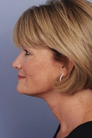 Comprehensive Facelift Before & After Gallery - Patient 313685 - Image 4