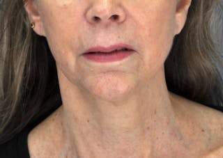 Ultherapy ™ Before & After Gallery - Patient 709019 - Image 2