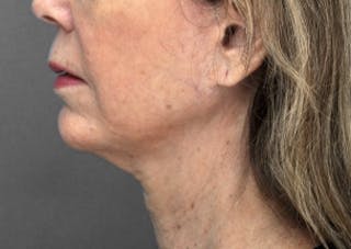 Ultherapy ™ Before & After Gallery - Patient 709019 - Image 4