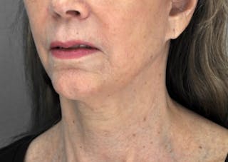Ultherapy ™ Before & After Gallery - Patient 709019 - Image 6