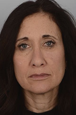 Mohs Reconstruction Before & After Gallery - Patient 278148 - Image 2