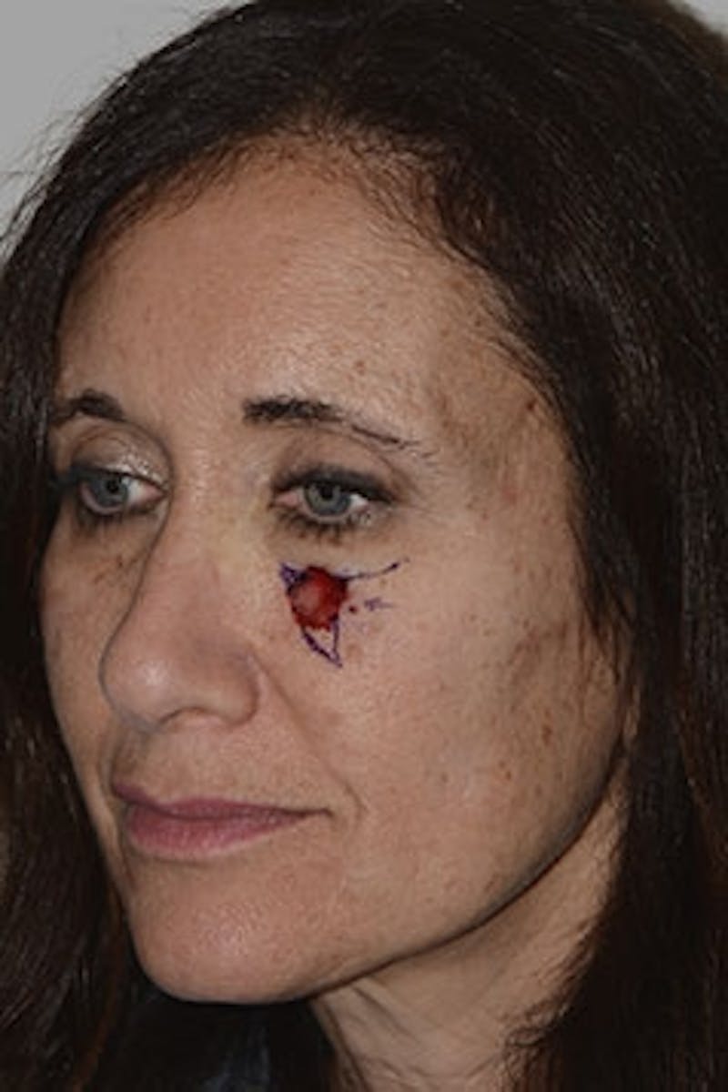 Mohs Reconstruction Before & After Gallery - Patient 278148 - Image 3