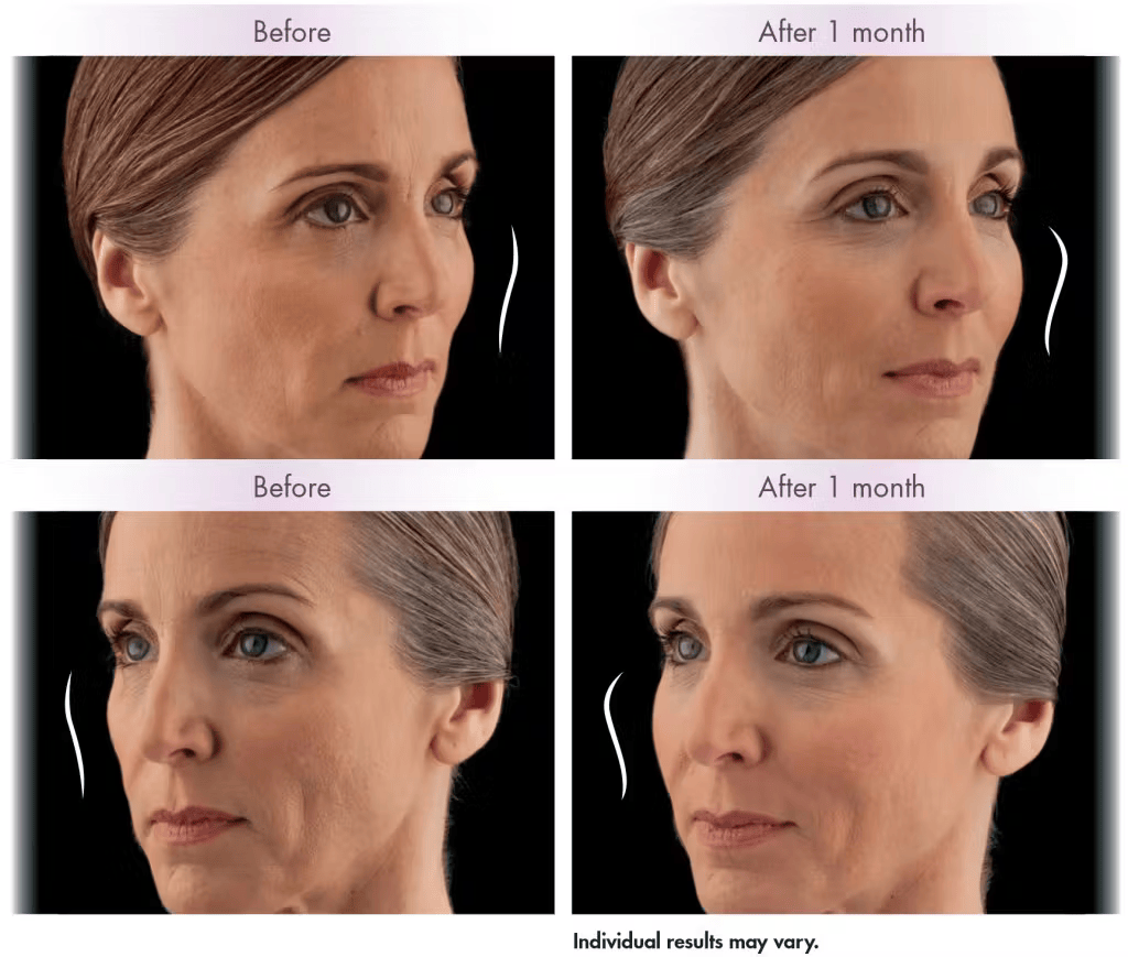 Juvederm before and after