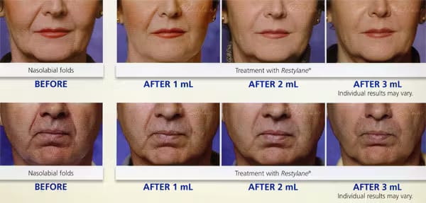 restylane patient results