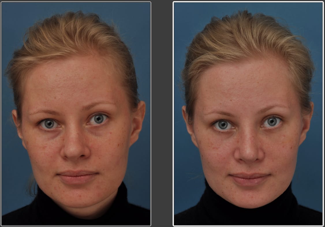 rhinoplasty patient results