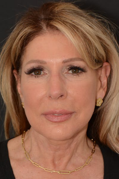 Rhinoplasty Before & After Gallery - Patient 217204 - Image 2