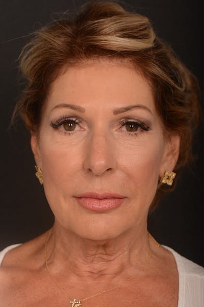 Rhinoplasty Before & After Gallery - Patient 217204 - Image 1