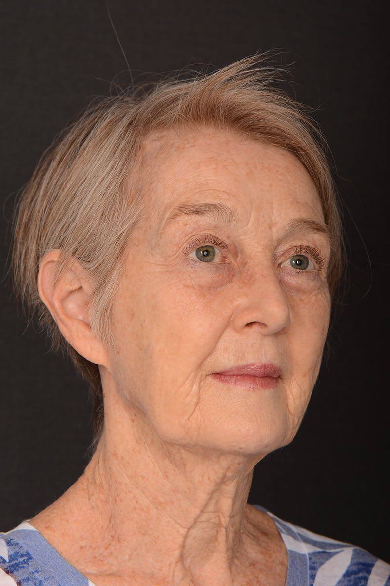 Facelift Before & After Gallery - Patient 246811 - Image 3