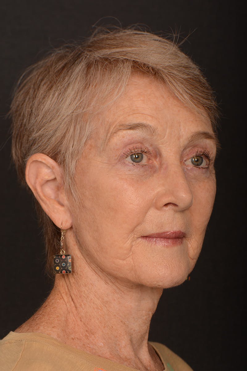 Facelift Before & After Gallery - Patient 246811 - Image 4