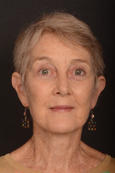Rhinoplasty Before & After Gallery - Patient 326814 - Image 2