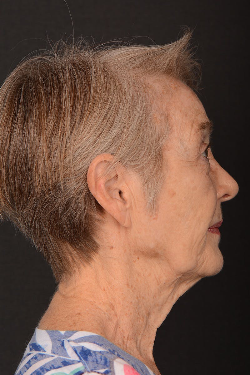 Facelift Before & After Gallery - Patient 246811 - Image 5