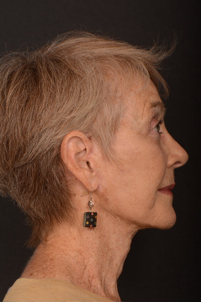 Facelift Before & After Gallery - Patient 246811 - Image 6