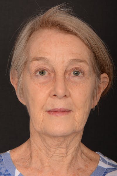 Rhinoplasty Before & After Gallery - Patient 326814 - Image 1