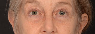 Blepharoplasty Before & After Gallery - Patient 977427 - Image 1