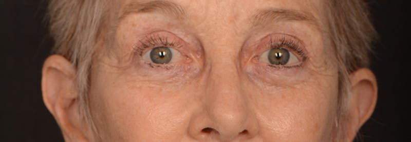 Blepharoplasty Before & After Gallery - Patient 977427 - Image 2