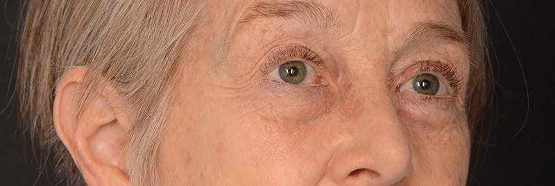 Blepharoplasty Before & After Gallery - Patient 977427 - Image 3