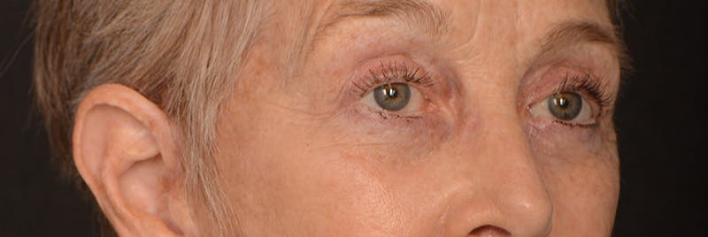 Blepharoplasty Before & After Gallery - Patient 977427 - Image 4