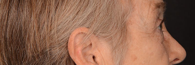 Blepharoplasty Before & After Gallery - Patient 977427 - Image 5