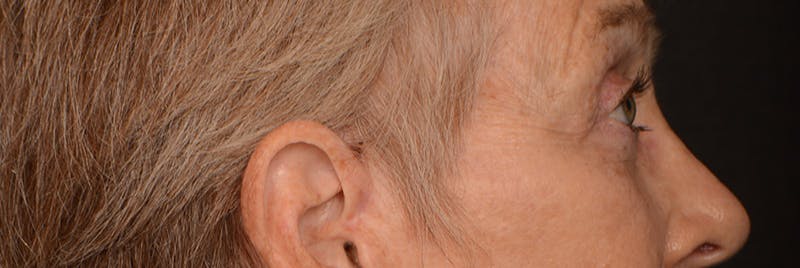 Blepharoplasty Before & After Gallery - Patient 977427 - Image 6