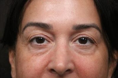 Eyelid Before & After Gallery - Patient 214764 - Image 1