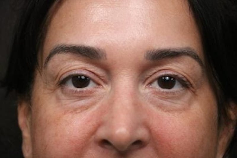Eyelid Before & After Gallery - Patient 214764 - Image 1