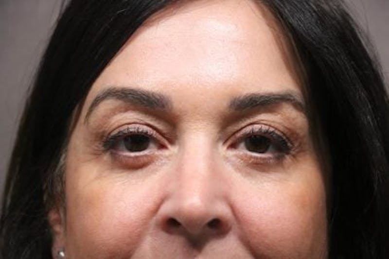 Eyelid Before & After Gallery - Patient 214764 - Image 2