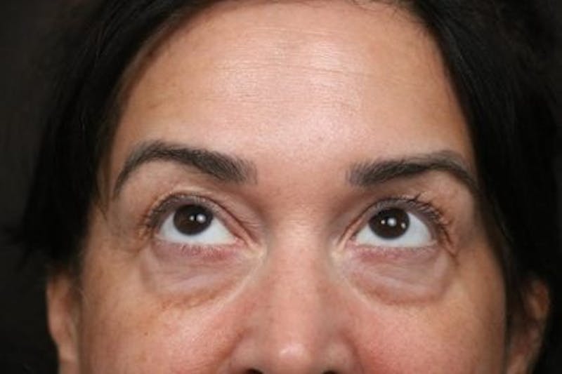 Eyelid Before & After Gallery - Patient 214764 - Image 3