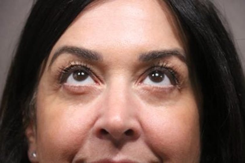 Eyelid Before & After Gallery - Patient 214764 - Image 4