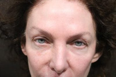 Eyelid Before & After Gallery - Patient 196666 - Image 1