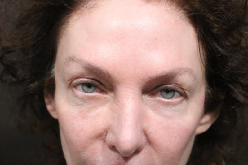 Eyelid Before & After Gallery - Patient 196666 - Image 1