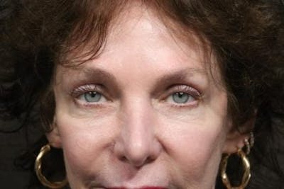 Eyelid Before & After Gallery - Patient 196666 - Image 2