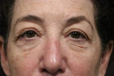 Eyelid Before & After Gallery - Patient 236375 - Image 1