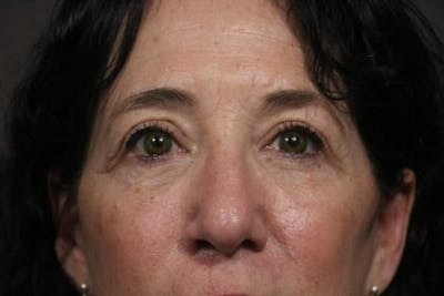 Eyelid Before & After Gallery - Patient 236375 - Image 2