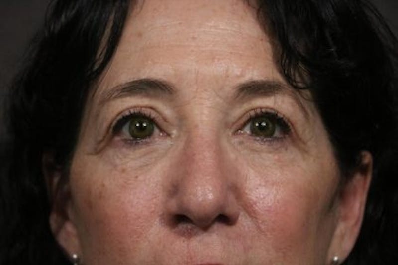 Eyelid Before & After Gallery - Patient 236375 - Image 2
