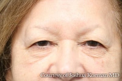 Eyelid Before & After Gallery - Patient 318707 - Image 1