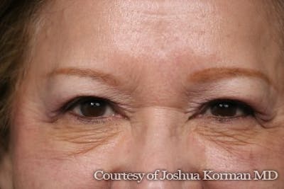 Eyelid Before & After Gallery - Patient 318707 - Image 2