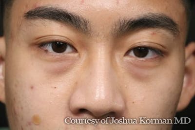 Eyelid Before & After Gallery - Patient 869939 - Image 1