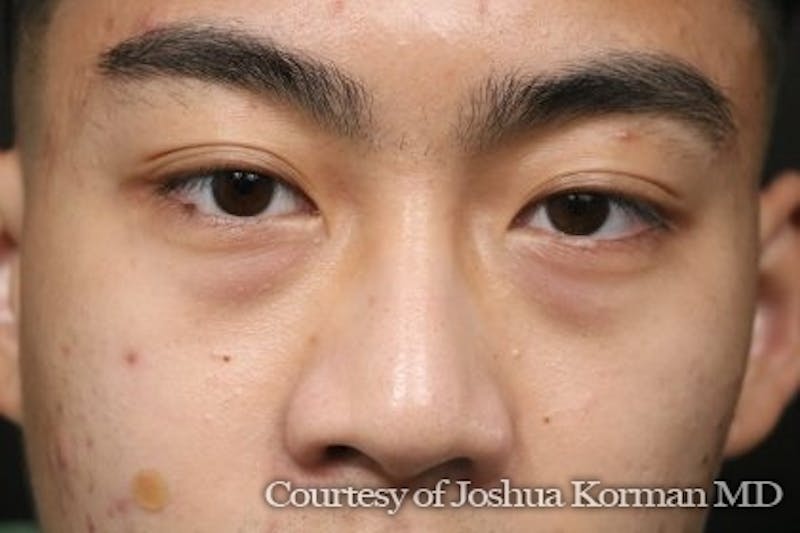 Eyelid Before & After Gallery - Patient 869939 - Image 1