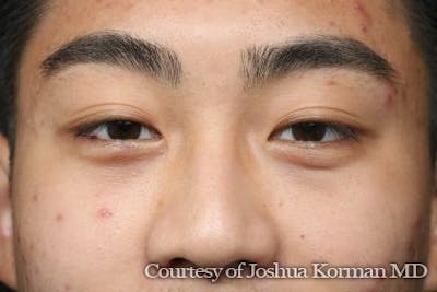 Eyelid Before & After Gallery - Patient 869939 - Image 2