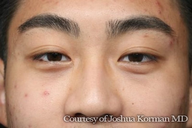 Eyelid Before & After Gallery - Patient 869939 - Image 2