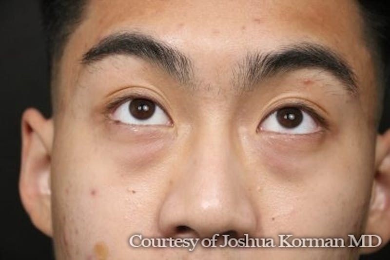 Eyelid Before & After Gallery - Patient 869939 - Image 3