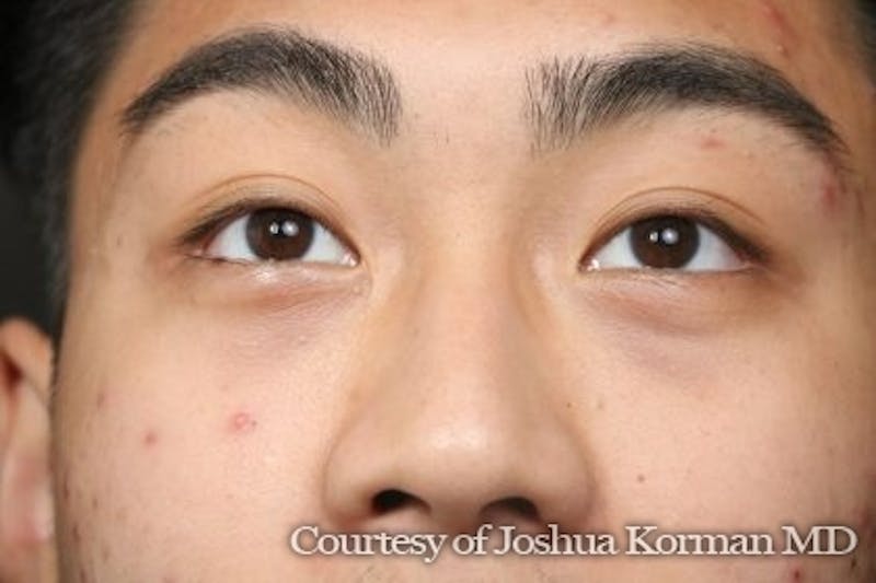 Eyelid Before & After Gallery - Patient 869939 - Image 4