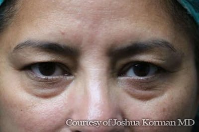 Eyelid Before & After Gallery - Patient 373958 - Image 1